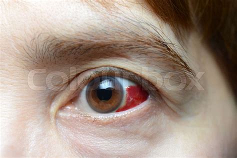 blood leaking from eye|Popped Blood Vessel in Eye: Causes, Treatment,。